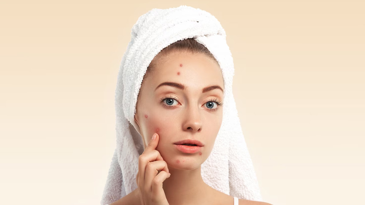 lemon leaves to remove pimples