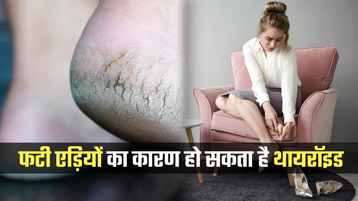 Cracked Heels: क्या क्रीम लगाने के बाद भी फटी एड़ियां कर रही है परेशान? डॉक्टर ने बताया Thyroid हो सकता है कारण