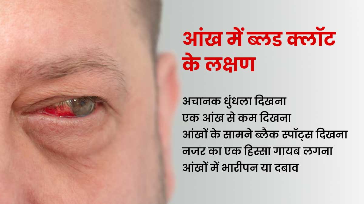 blood-clot-in-eye