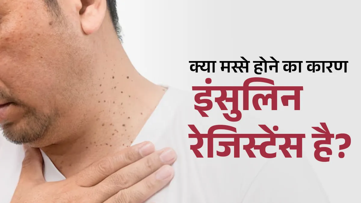 क्या बार-बार हो रहे हैं मस्से होने का कारण कहीं इंसुलिन रेजिस्टेंस तो नहीं? डॉक्टर से समझें कनेक्शन