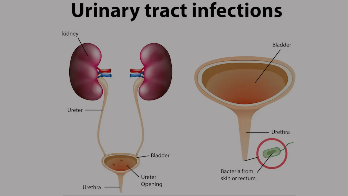 UTI-in-women-during-monsoon