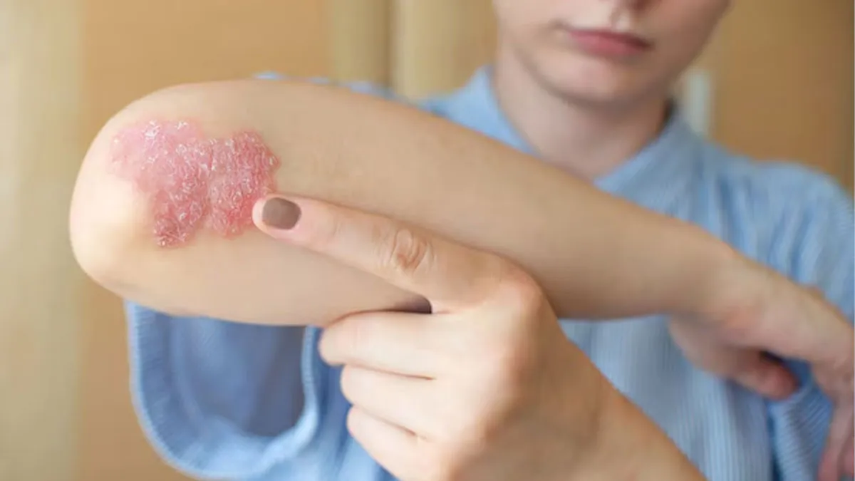 Causes-of-recurrent-fungal-infections-inside