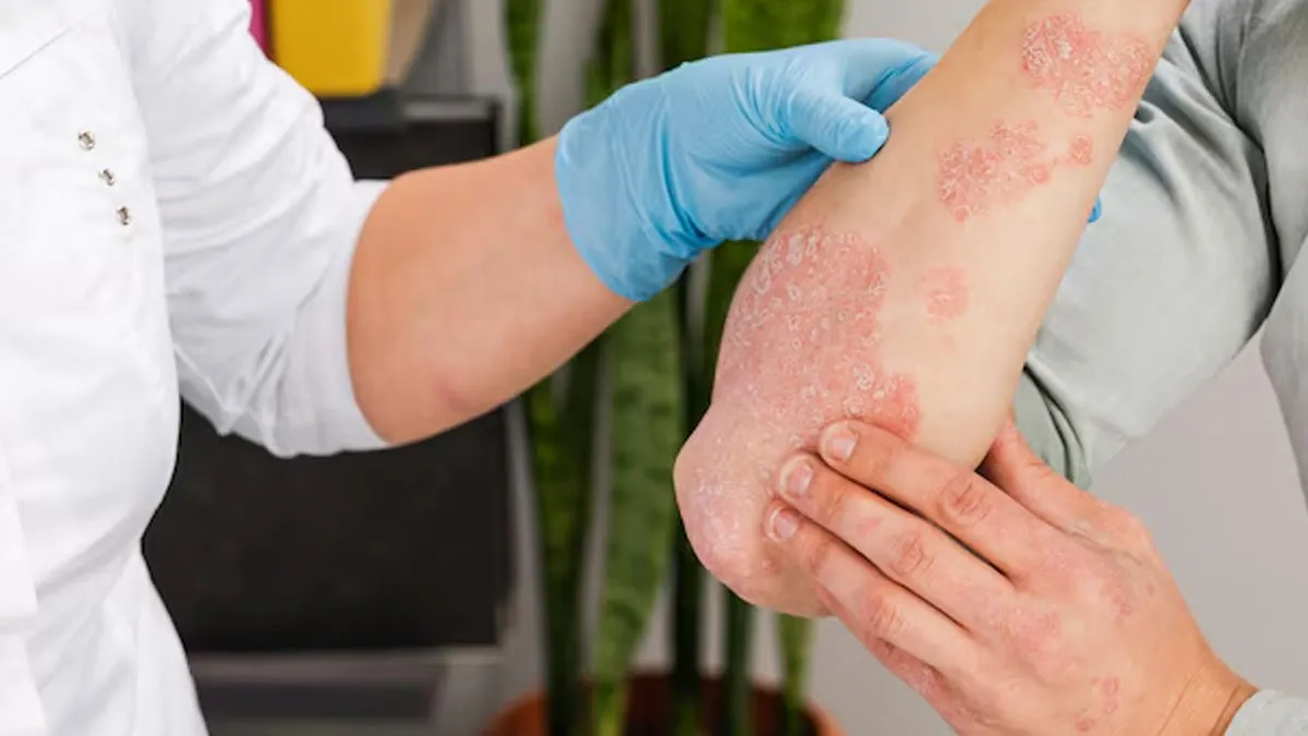 eczema-in-hindi