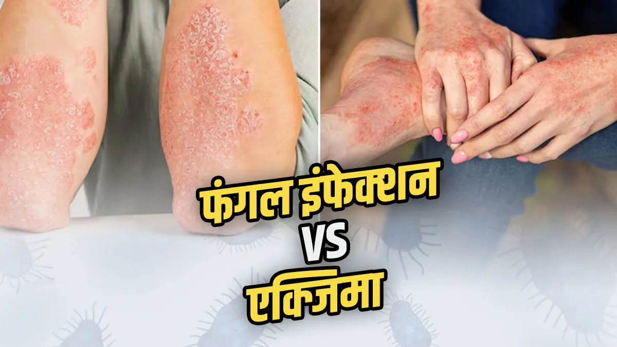 फंगल इंफेक्शन vs एक्जिमा: क्या है अंतर? डर्मेटोलॉजिस्ट से जानें लक्षण, कारण और इलाज