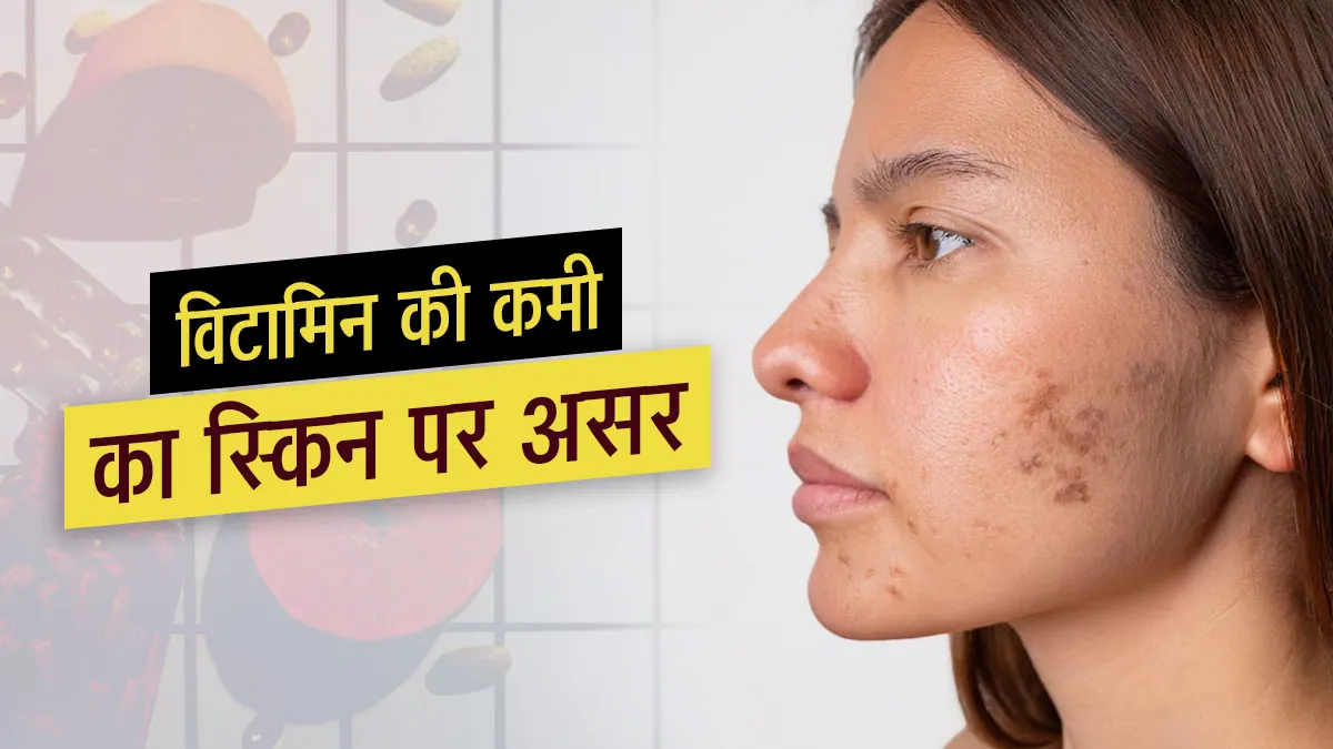 क्या विटामिन्स की कमी से त्वचा का रंग बदल सकता है? डॉक्टर से जानें