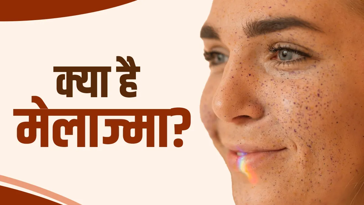 चेहरे के काले-भूरे धब्बों को न करें नजरअंदाज, मेलाज्मा का हो सकता है संकेत
