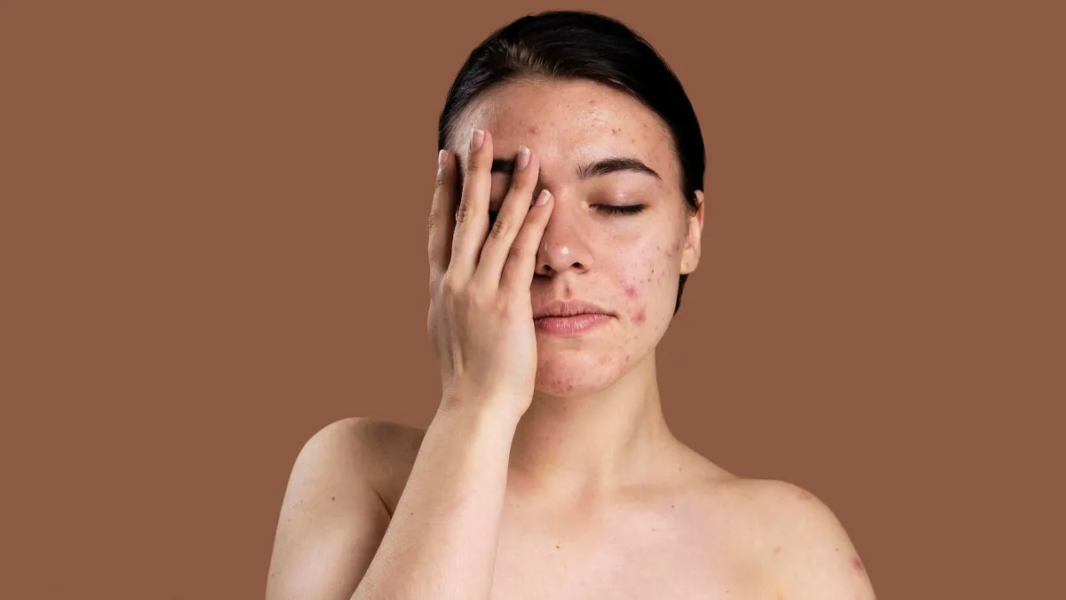 dairy-products-cause-acne-inside