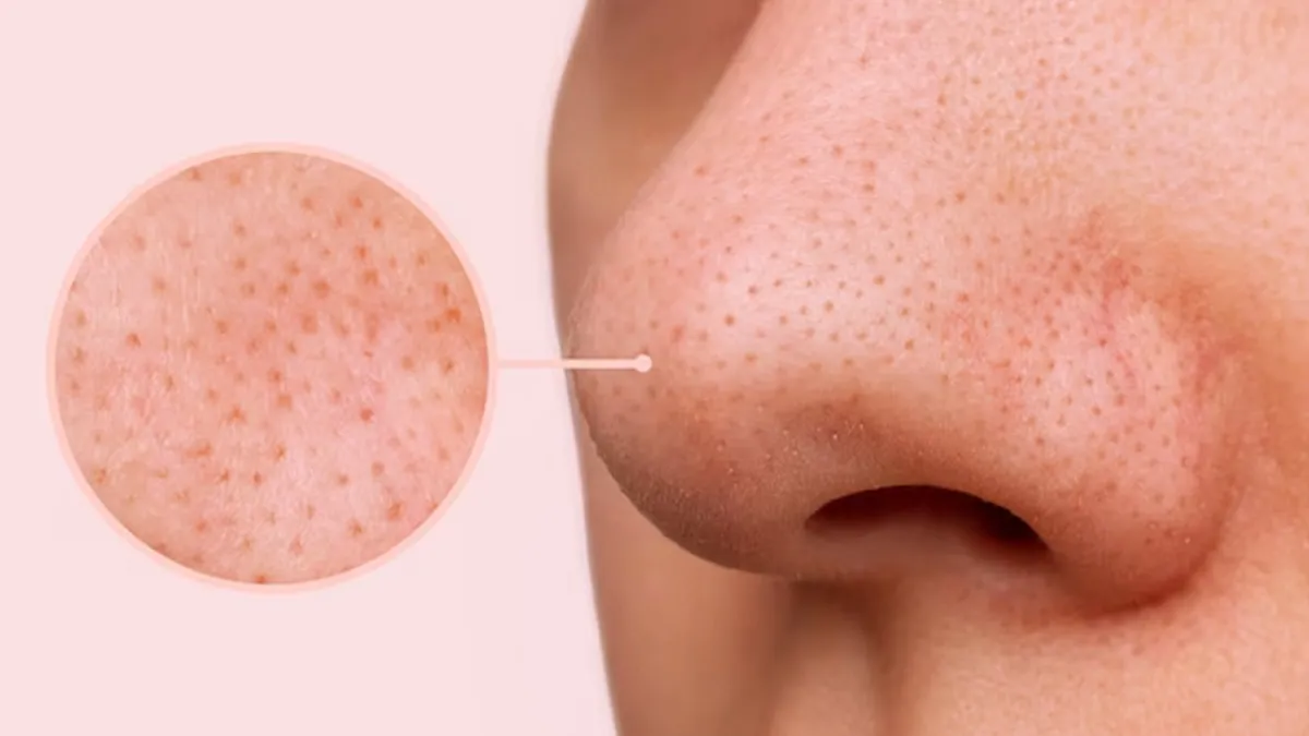 why are small pores more visible around the nose 1