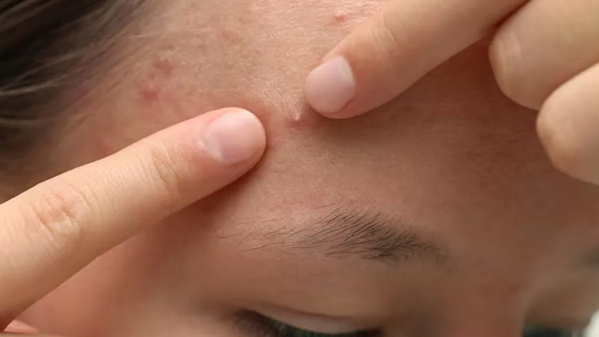 why do small bumps keep appearing on the forehead  1