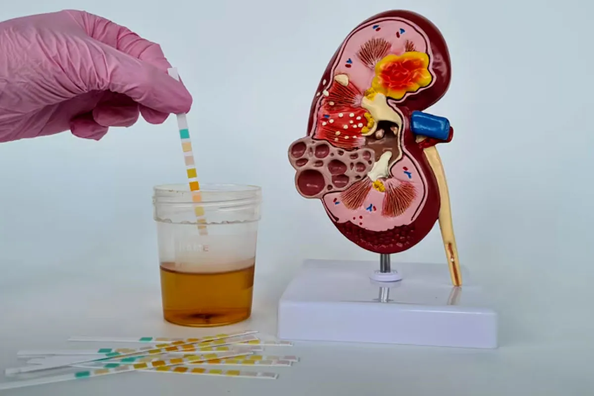 urine stream diseses