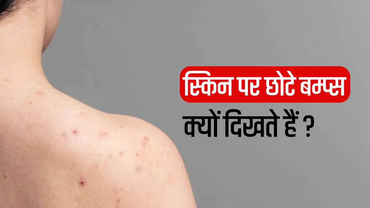 त्वचा पर अचानक छोटे बम्प्स क्यों दिखाई देने लगते हैं? डॉक्टर से जानें