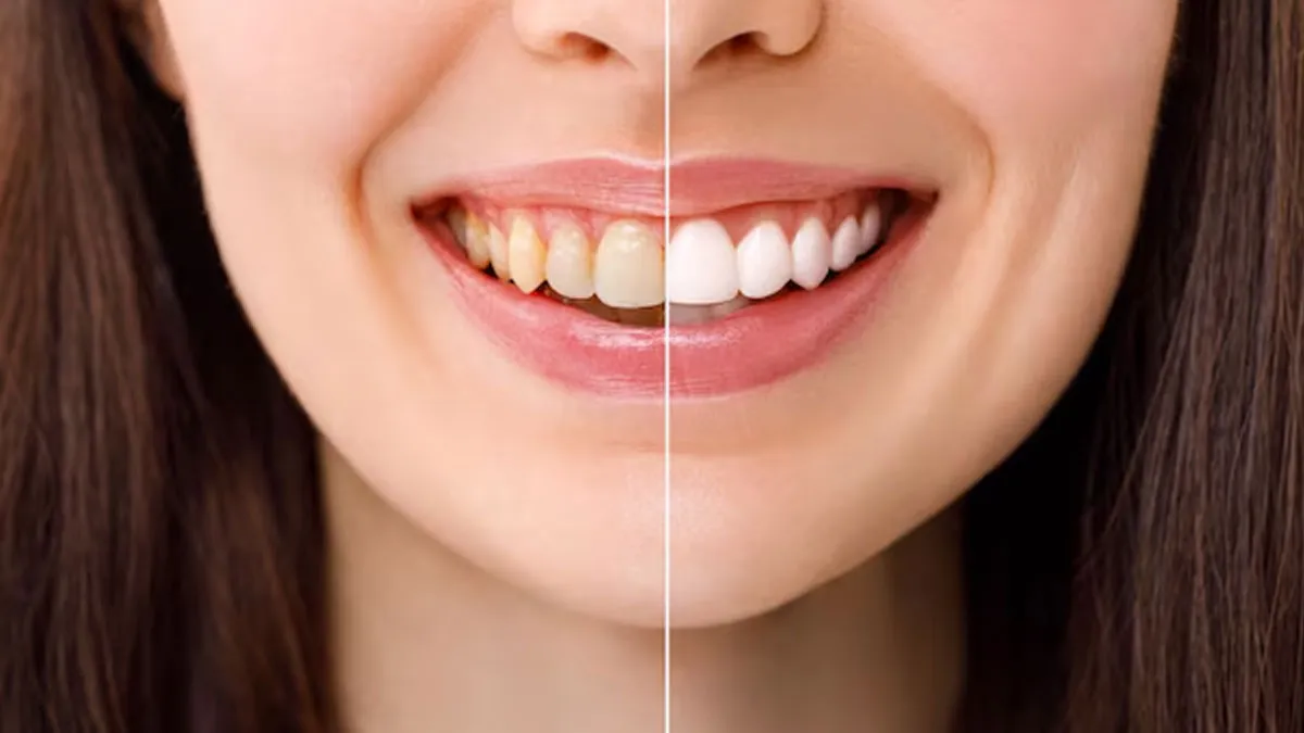 Tooth Sensitivity After Teeth Whitening
