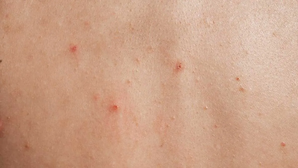 why do small bumps suddenly appear on the skin 01