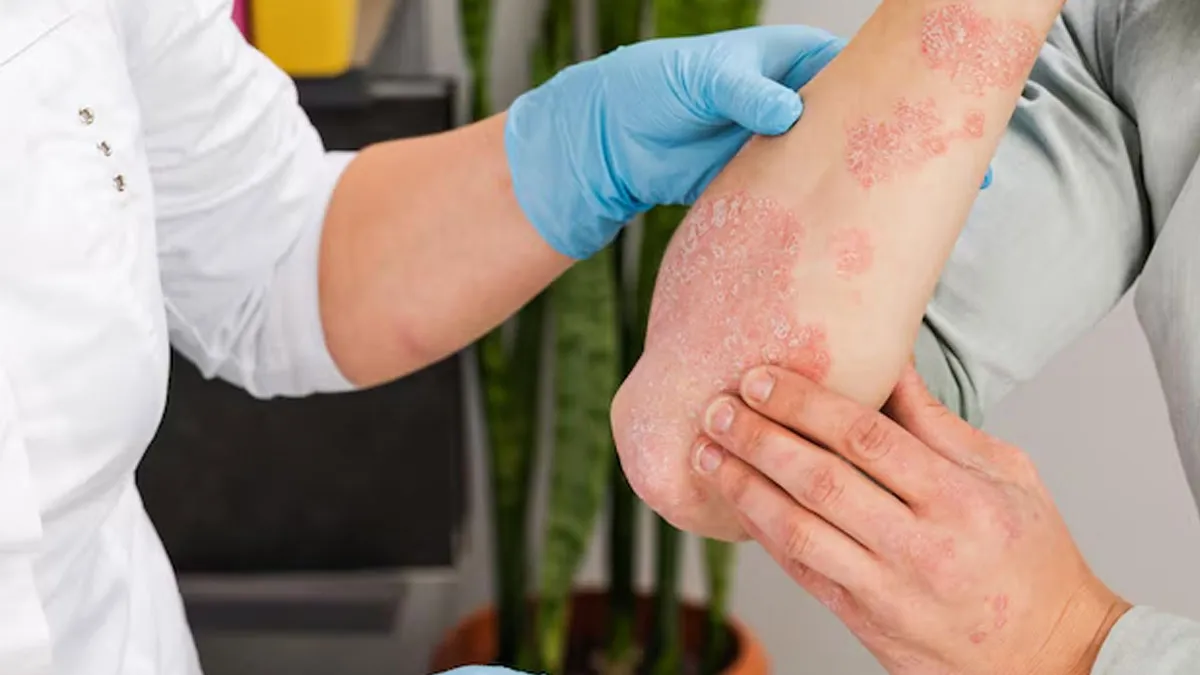 is psoriasis just a skin disease or systemic condition 1
