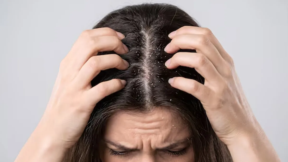 dandruff-vs-dry-scalp-inside