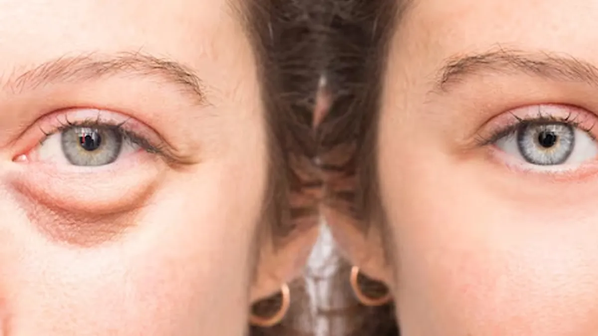 puffy-eyes-treatment-in-hindi