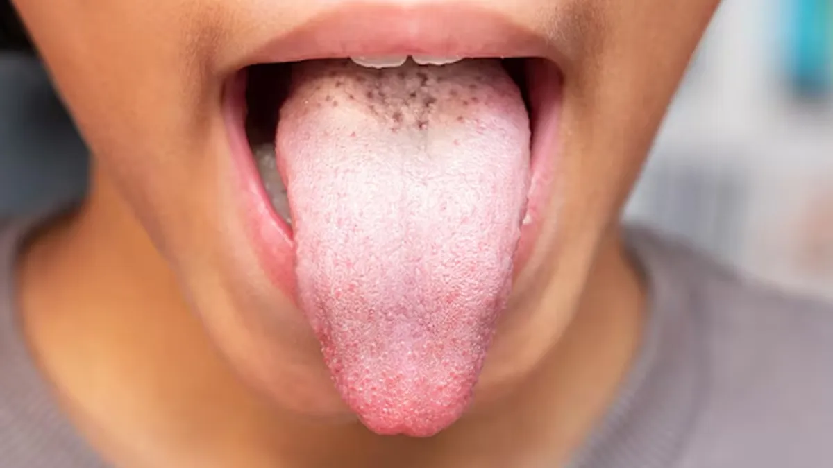 why does a white coating form on the tongue 01