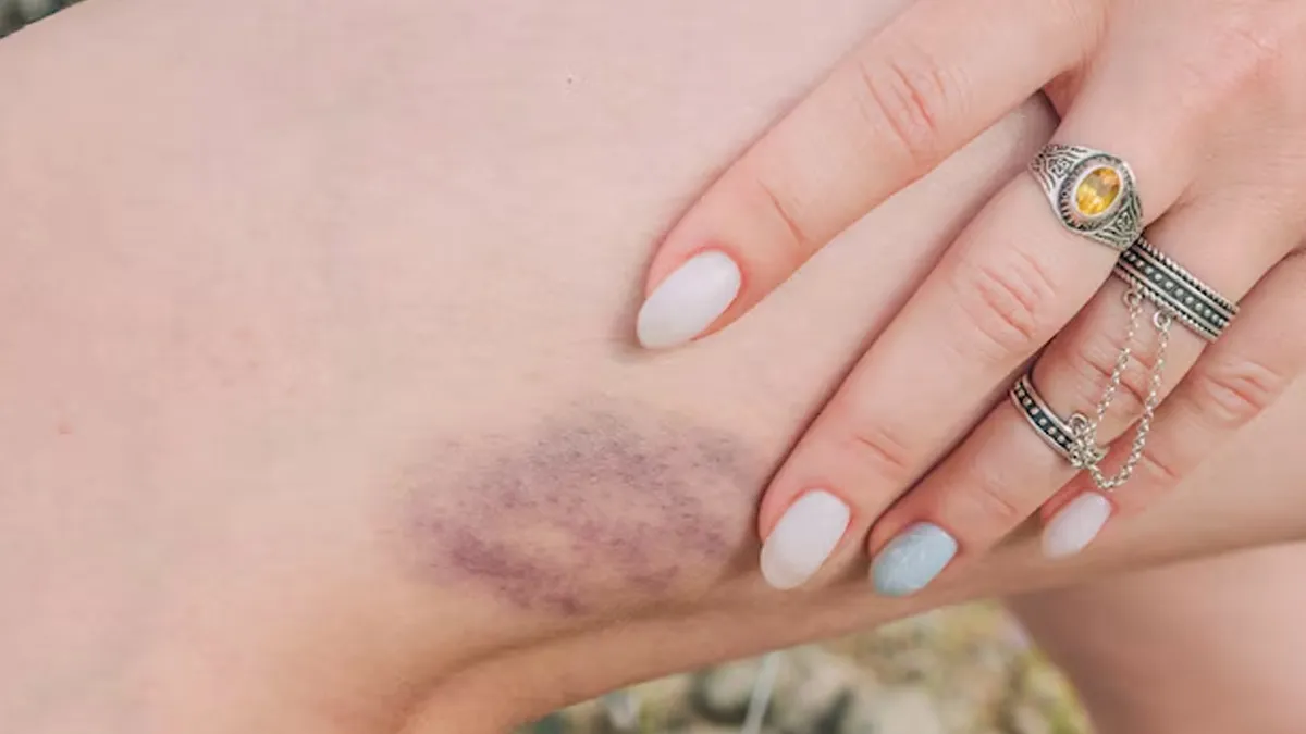 reasons for blue spots or bruises on skin