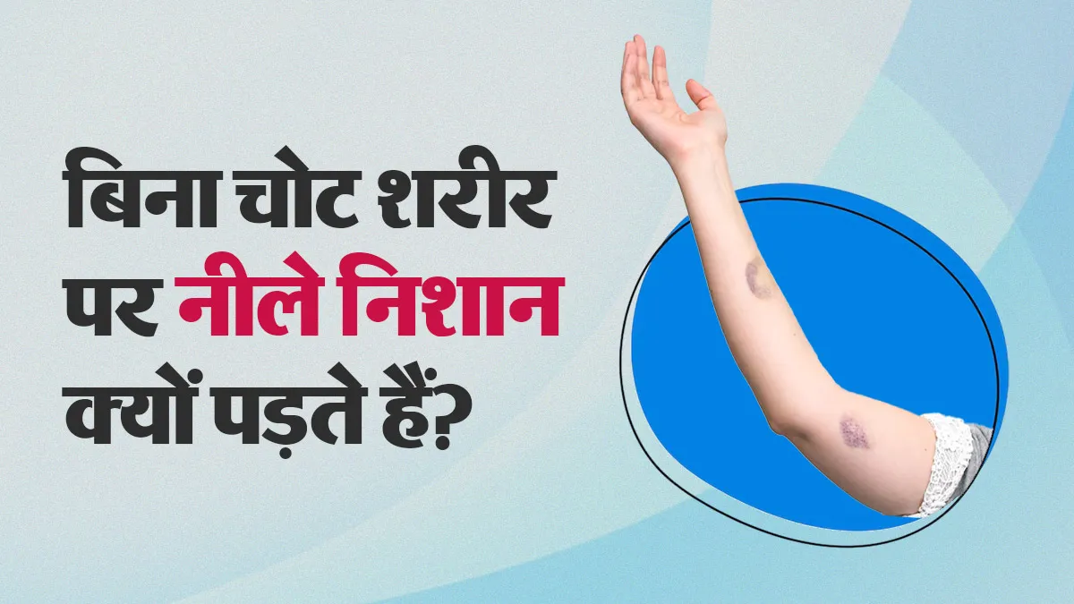 बिना चोट शरीर पर पड़ रहे हैं नीले निशान, जानें कारण और कब डॉक्टर को दिखाना जरूरी?