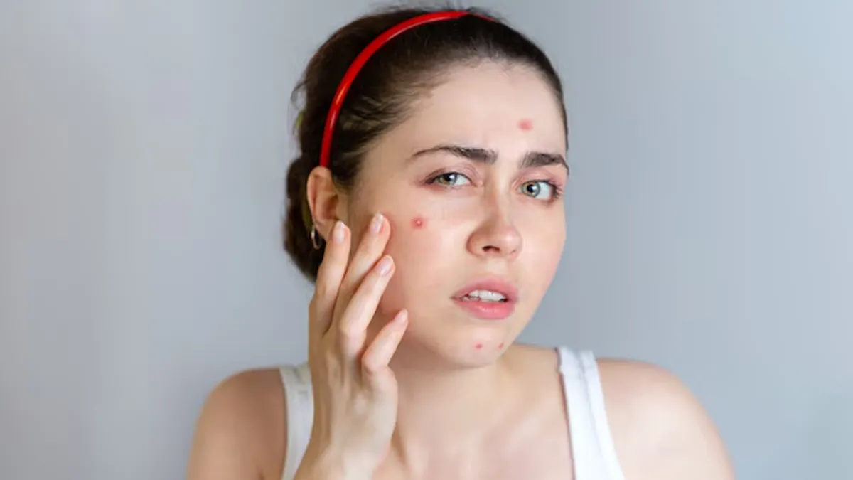 why do pimples keep appearing in the same spot 01