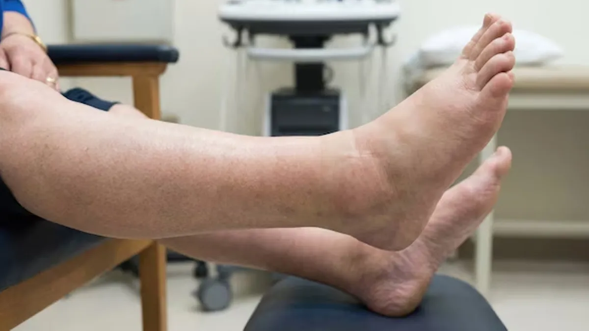 leg-swelling-kidney-disease