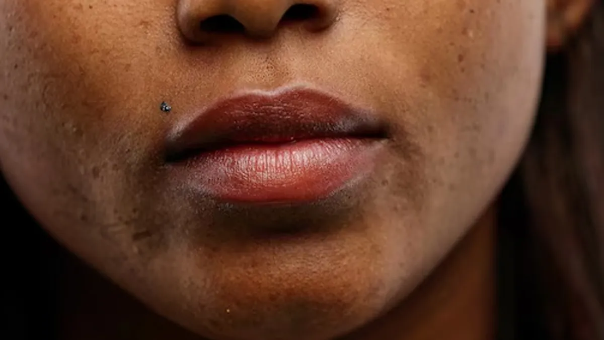 pigmentation-around-mouth