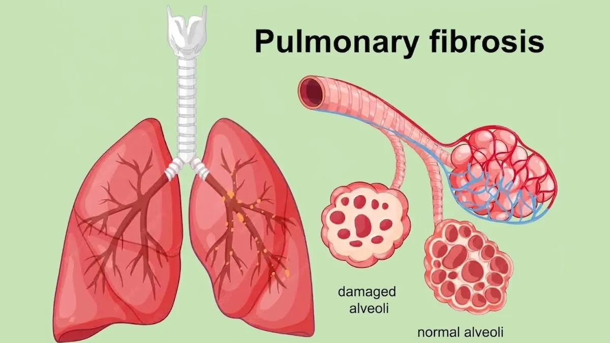 pulmonary-fibrosis