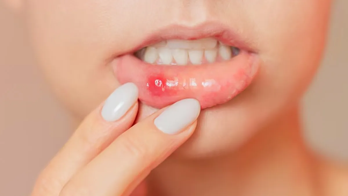 herbs-for-mouth-ulcer