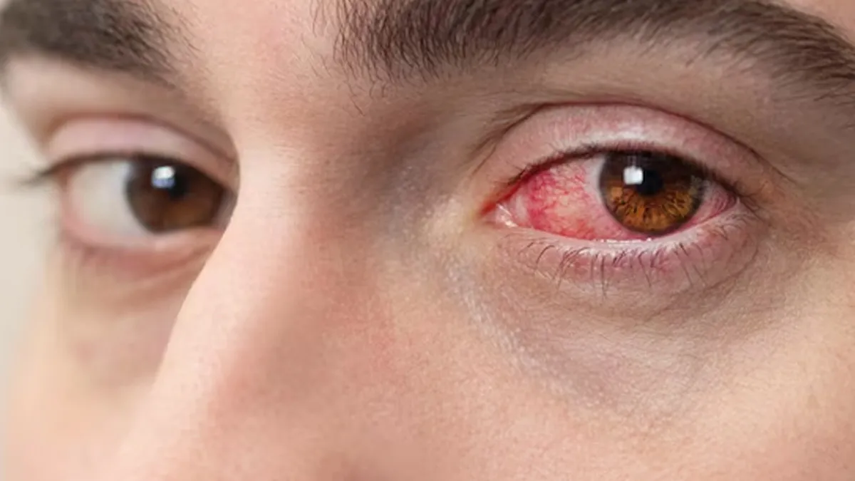 eye pain with headache ophthalmologist explains possible cause 01
