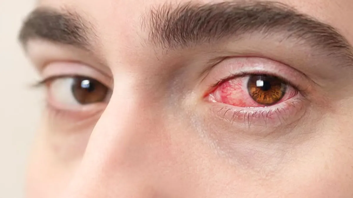 why are your eyes red when you wake up in the morning 1