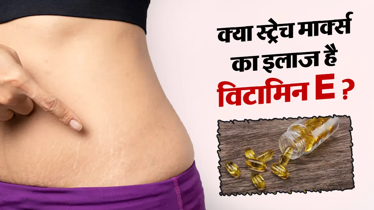 क्या स्ट्रेच मार्क्स कम करने में वाकई असरदार है विटामिन E ऑयल? जानें डर्मेटोलॉजिस्ट की राय