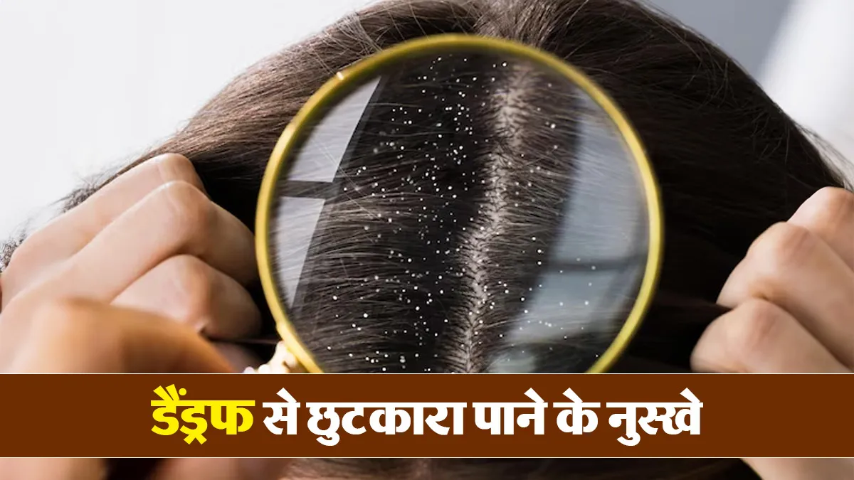 डैंड्रफ से हैं परेशान? अपनाएं ये 3 असरदार घरेलू नुस्खे
