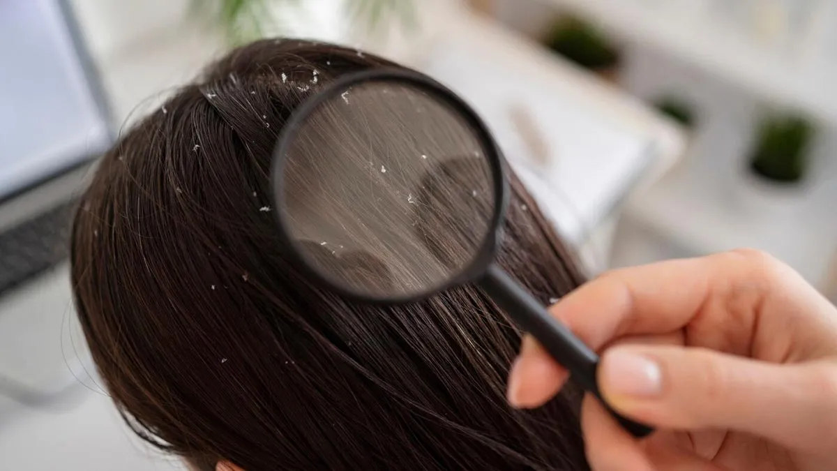 Home-Remedy-For-Dandruff