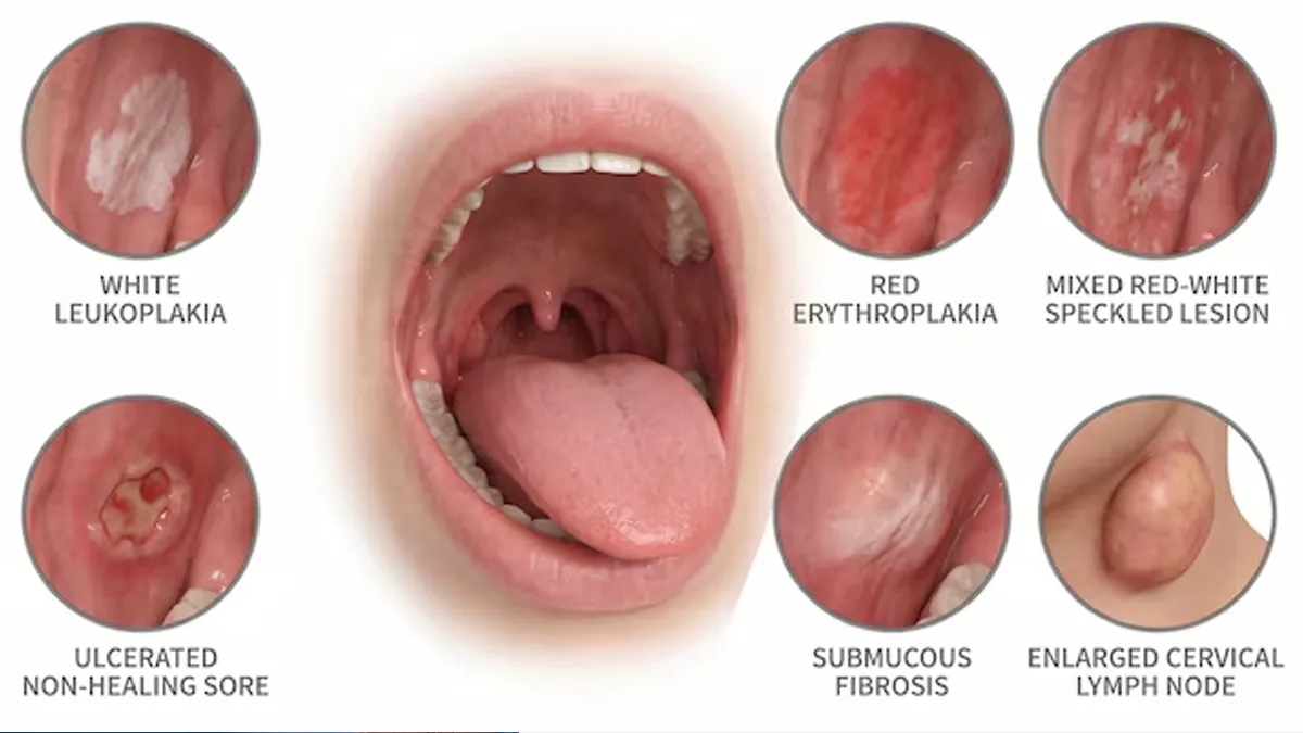 Causes Of Mouth Cancer