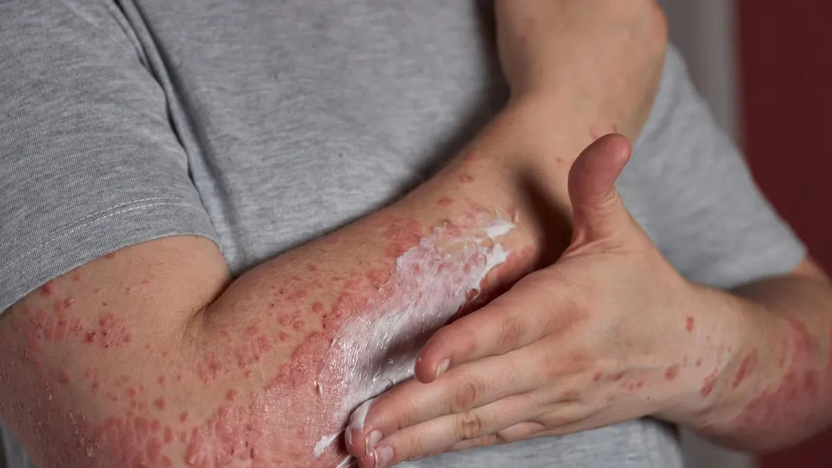 Is It Good To Use Moisturizer On Skin With Psoriasis