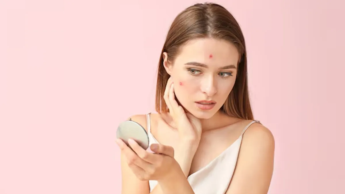 Clove Water Benefits For Oily and Acne