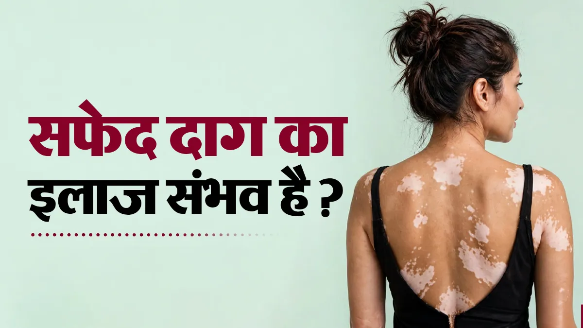 क्या सफेद दाग पूरी तरह ठीक हो सकता है? डॉक्टर से जानें इलाज और किन बातों का रखें ध्यान