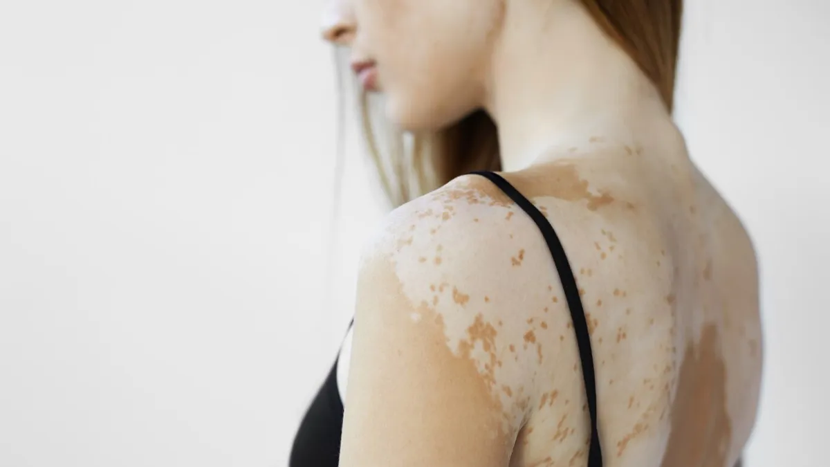 Can vitiligo go away permanently