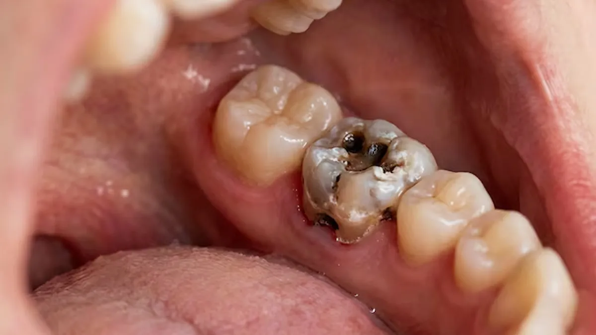 when-is-tooth-extraction-is-necessary