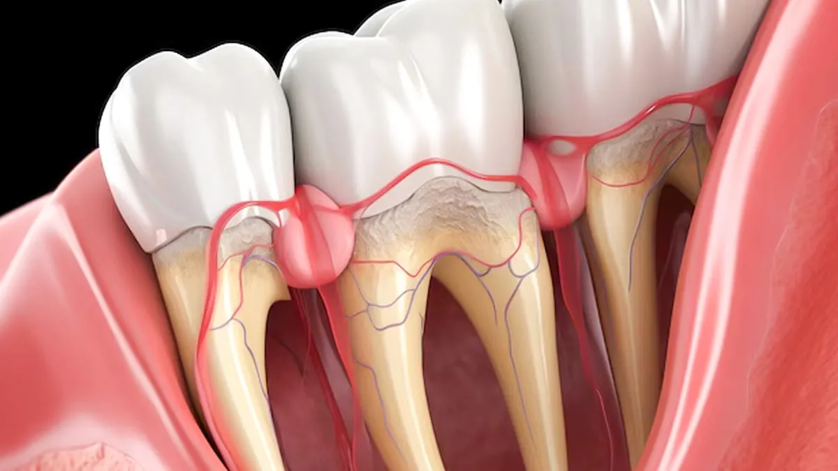 when-it-is-necessary-to-remove-wisdom-tooth