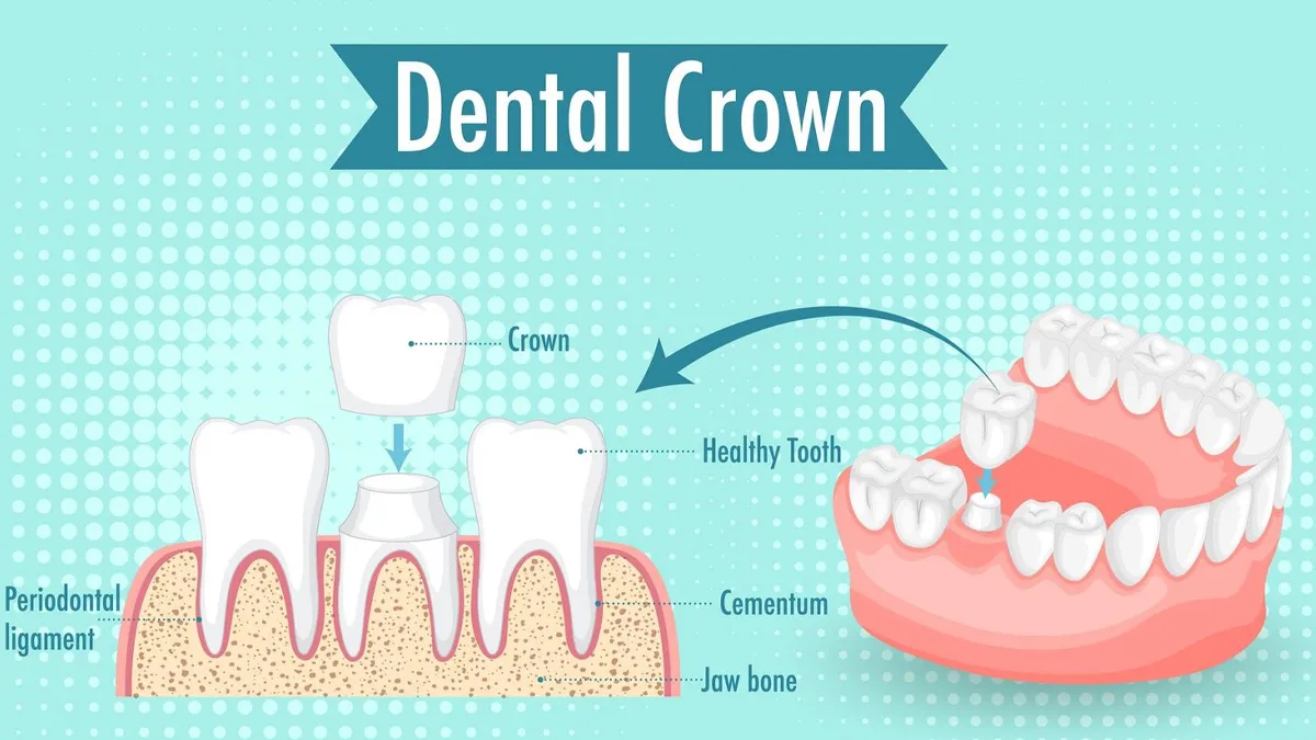when-dental-cap-is-necessary