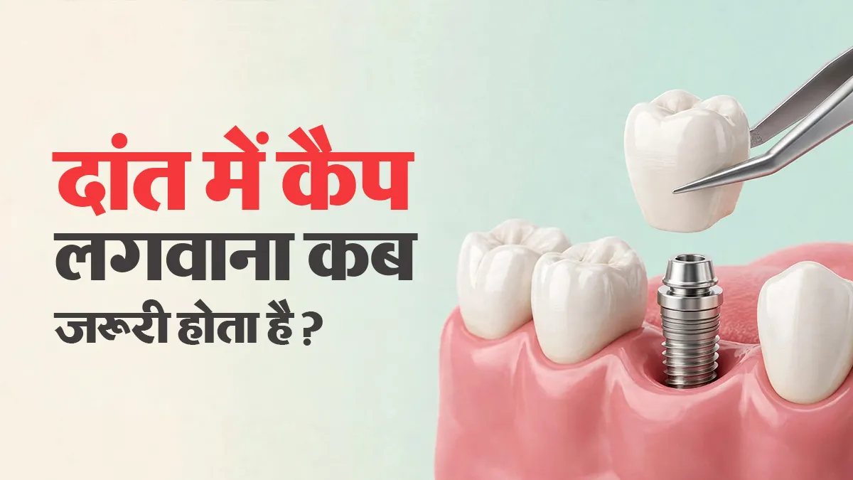 दांत में कैप (क्राउन) लगवाने की जरूरत कब पड़ती है? जानें क्या कहते हैं डेंटिस्ट