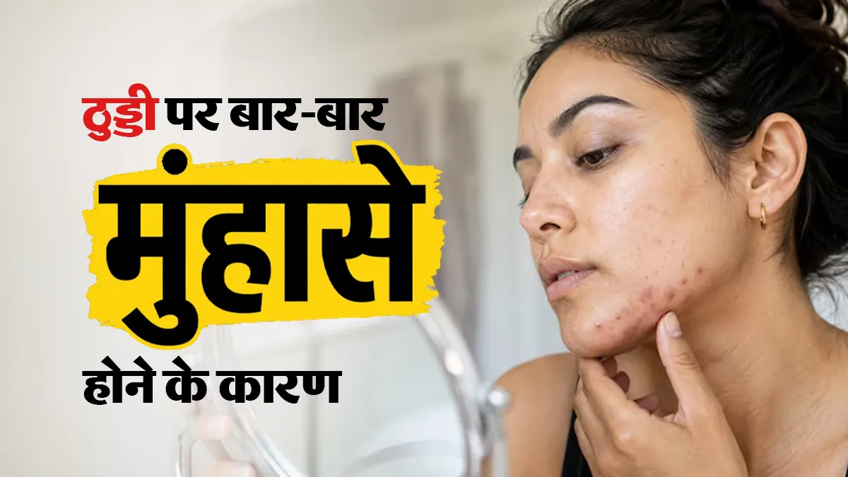 ठुड्डी पर बार-बार मुंहासे निकलने की क्या वजह है? डॉक्टर से जानें