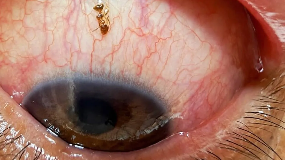 how-to-get-rid-of-bug-in-eye