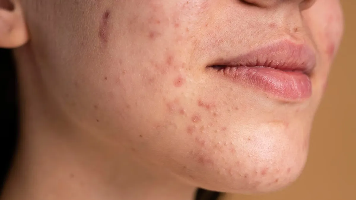 Methi Paste Benefits for Skin