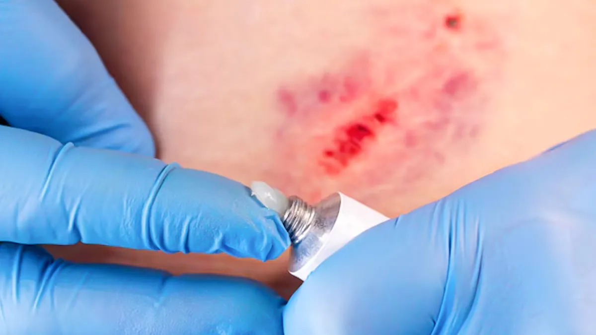 5 Signs Of Surgical Wound Infection