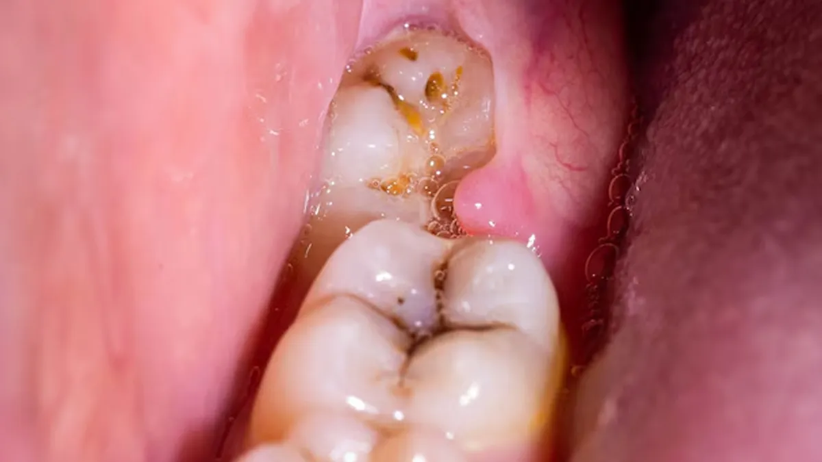 black-spot-on-teeth-is-always-cavity-or-not