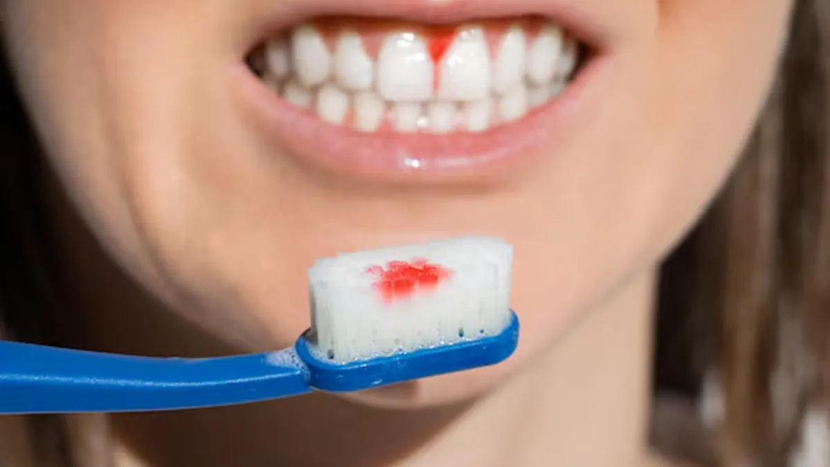 bleeding gums causes and prevention