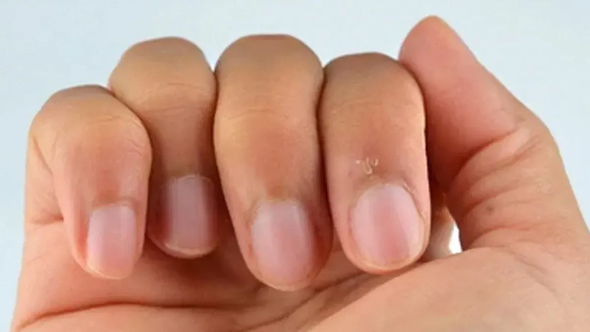 Causes-of-Skin-Peeling-Near-Nails