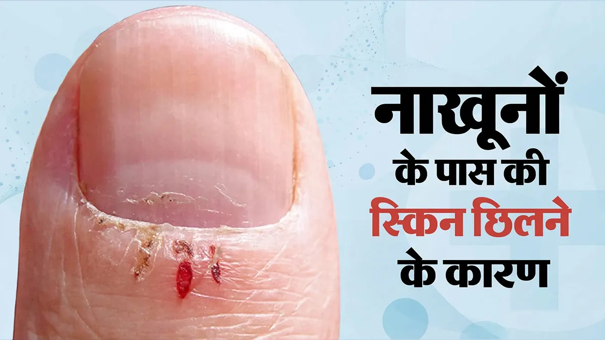 क्या आपकी भी फटने लगी है नाखूनों के पास की स्किन? डॉक्टर से जानें इसके कारण
